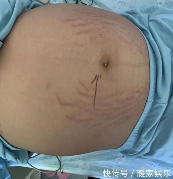 囊肿|13岁女生肚子隆起爬满“妊娠纹”,照完CT妈妈当场吓懵