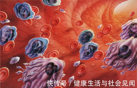 得癌|于加军答:为什么会得癌?"癌"究竟是什么?