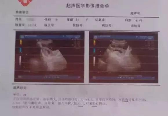 双顶径|B超单看男女?3分钟教你看懂B超检查单,简直不要太详细!