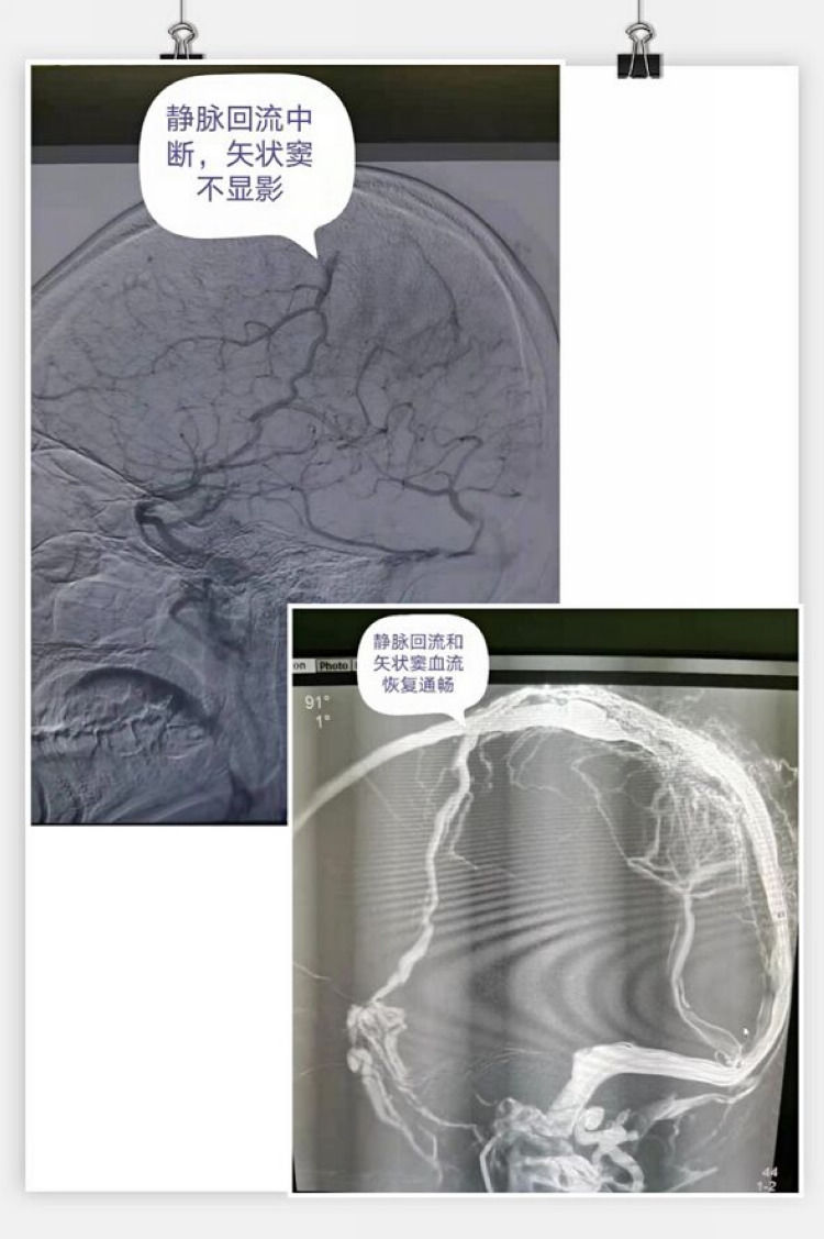 大脑|熬夜玩游戏,24岁小伙脑出血加脑梗偏瘫