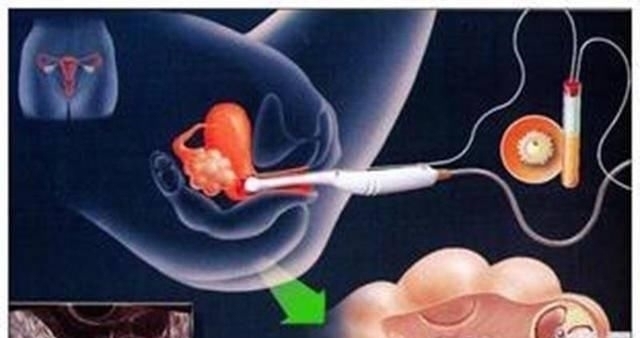 培养箱|揭秘试管婴儿全过程(附图),看完后心疼女性一万遍