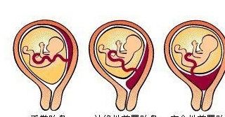 流产|孕期常识：孕妈妈若阴道流血、腹痛，很有可能跟4种情况有关！