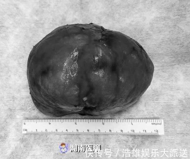 为人父母|2月婴儿肚中取出八两肿瘤!医生提醒父母孕前做好这一步可预防