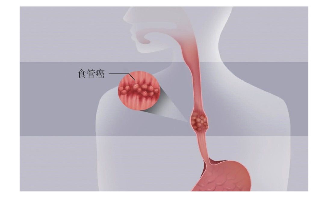 病变|常吃腌制食物，喜烫食、烫饮……改善这些不良饮食习惯，食管癌远离你