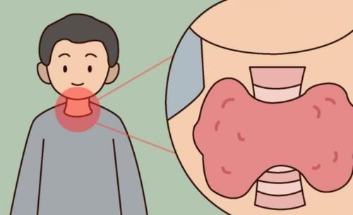 有甲狀腺結節的中老年人，這幾個行為要杜絕，別讓問題更復雜