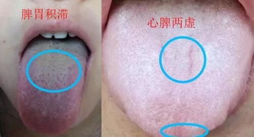 香砂六君丸|身上没劲肚子胀,大便不成型,齿痕舌脾虚中成药有哪些