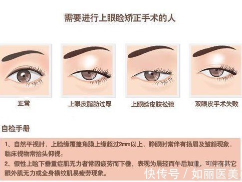 求美者 上睑下垂术后多久恢复自然?其实这1点才更该重视