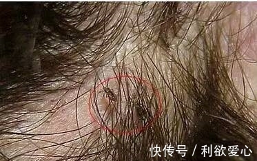 小狗狗|5岁孩子总说浑身很痒,医生仔细一检查,结果发现一物想要呕吐