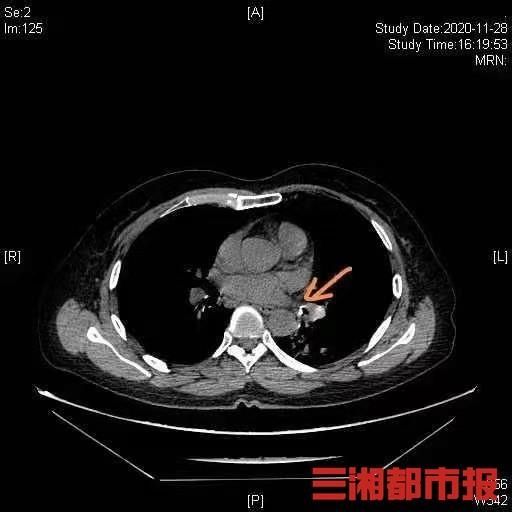 长沙阿姨莫名咳嗽五年，祸首竟是一根鸡骨头