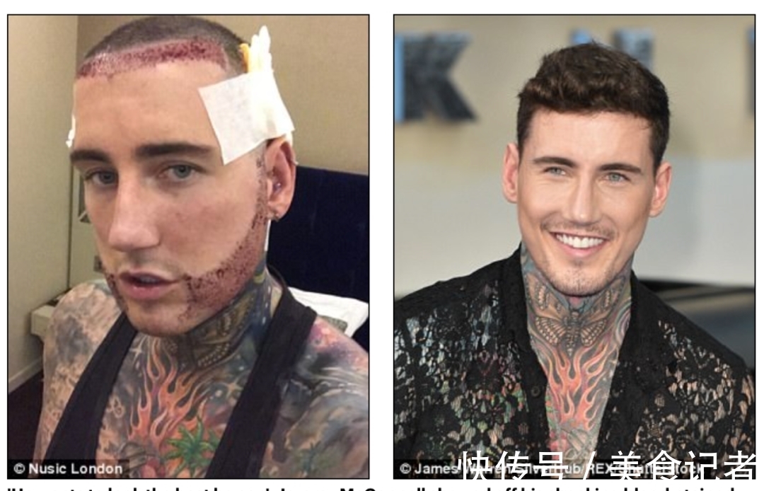 chris 每个月到底有多少人去土耳其植发?