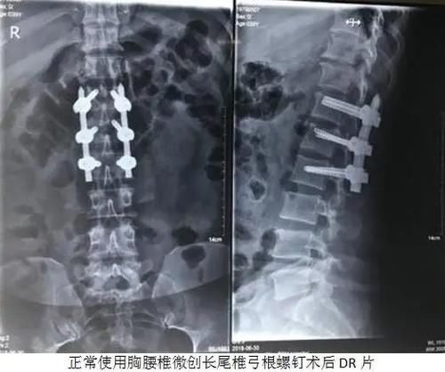 郑州一医生举报两名科主任：私自替换手术骨科螺钉，点名要收 40％ 回扣