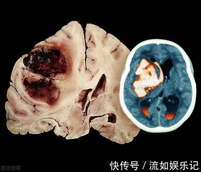 头晕头痛|53岁大妈1年脑出血3次，医生怒斥：人老了，4件事还不控制好