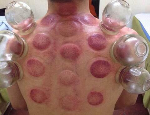 中年|别再傻傻的去花钱拔罐了!教你一个绝招,有效去湿气还不花一分钱