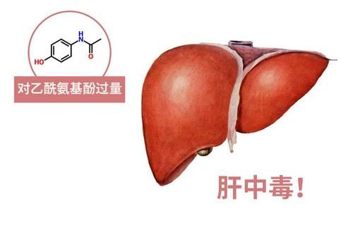 医生|膝关节退变疼痛难忍，吃点对乙酰氨基酚就行了，不用看医生？