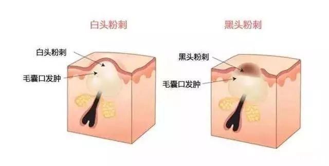 ME小科普:总是长痘痘怎么办?痘痘、闭口、粉刺你能分得清吗?