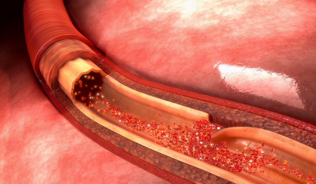 秘诀|真正降血压的秘诀找到了，不是戒烟酒，若能做到，血压或许稳如山