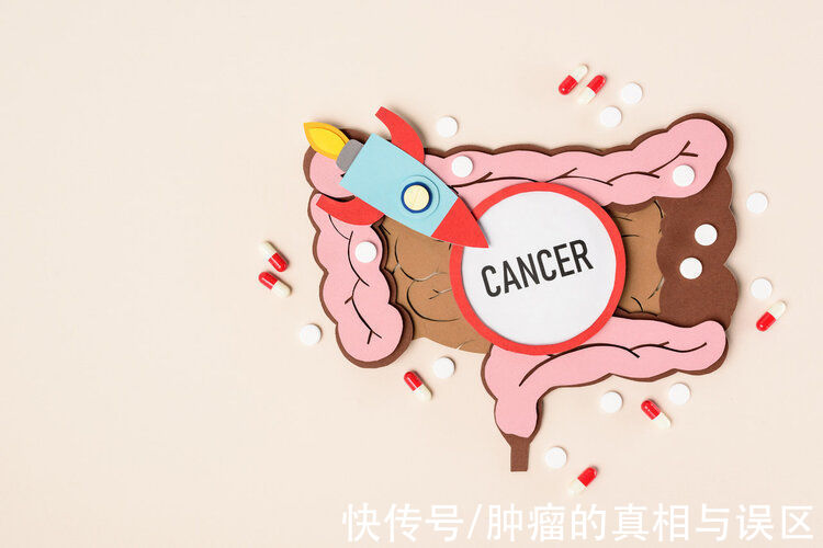 肠镜|多数人发现肠癌是在第一次做肠镜时，如出现5种不适，赶紧检查