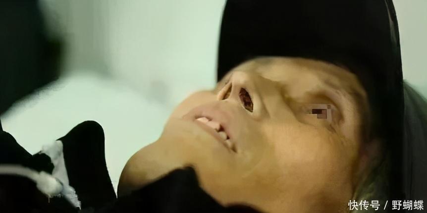 60岁男子,腹痛入院,查出胃癌,提醒这东西真不能总吃