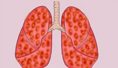 患者|医生坦言:最不希望患者碰到3种癌,发作前毫无征兆,要早作预防