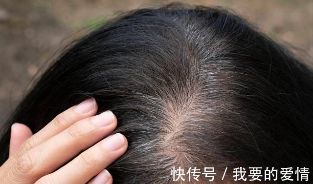 小妙招 白发多也不要频繁染发,伤发又上头皮,这四个小妙招解决白发困扰!
