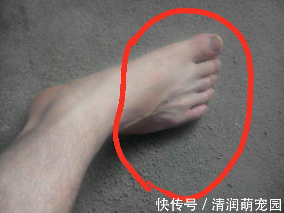 胆汁|肝不好，脚先知！若脚上出现这5种状况，表明您的肝越来越不好了