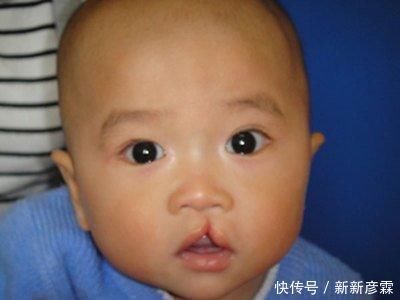 产妇生出“兔唇儿”，谎称孕期吃了兔肉，被医生揭穿后婆婆很恼火