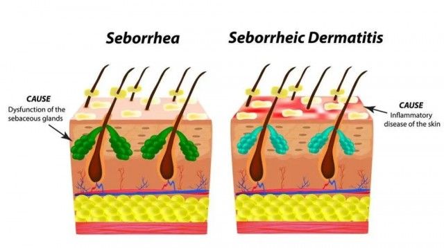 脱发|来自皮肤科医生的警告:头屑多,可能是脱发前兆