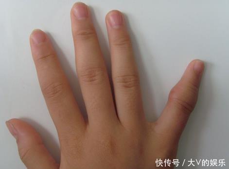 留情|一旦手部出現3大怪象,多半已被血栓“拴住”4種食物口下別留情