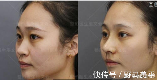 鼻头 为什么很多医生不建议做单纯鼻头鼻翼缩小?这项手术到底能做吗?