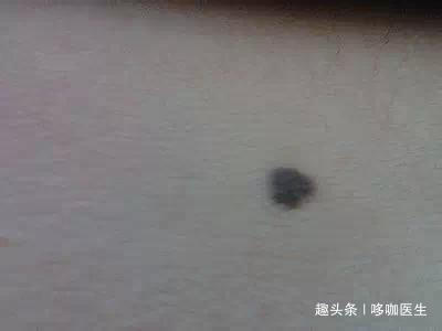 粘膜|60岁大爷抠手患癌,医生提醒手欠会诱发癌症