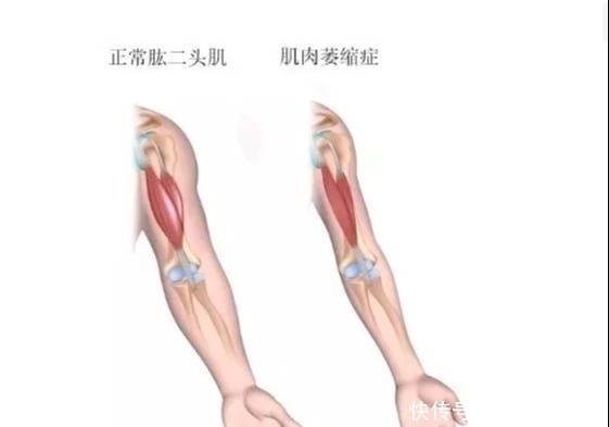 遗传|肌营养不良症是什么引起来的？肌营养不良能治好吗？