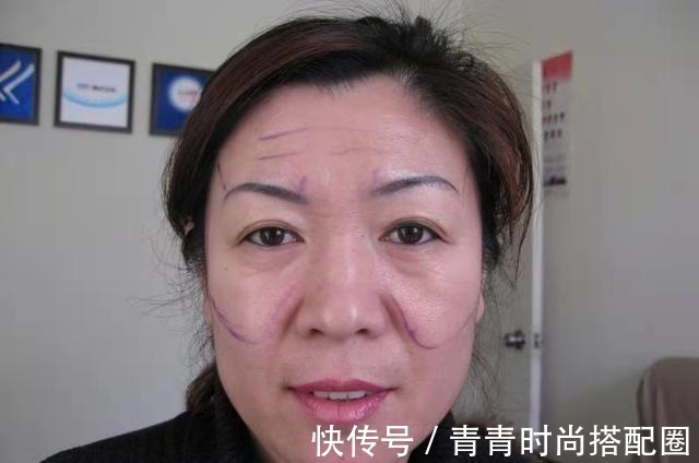 拉皮手术 颞部切口小拉皮术后即刻,老公没找到切口在哪!