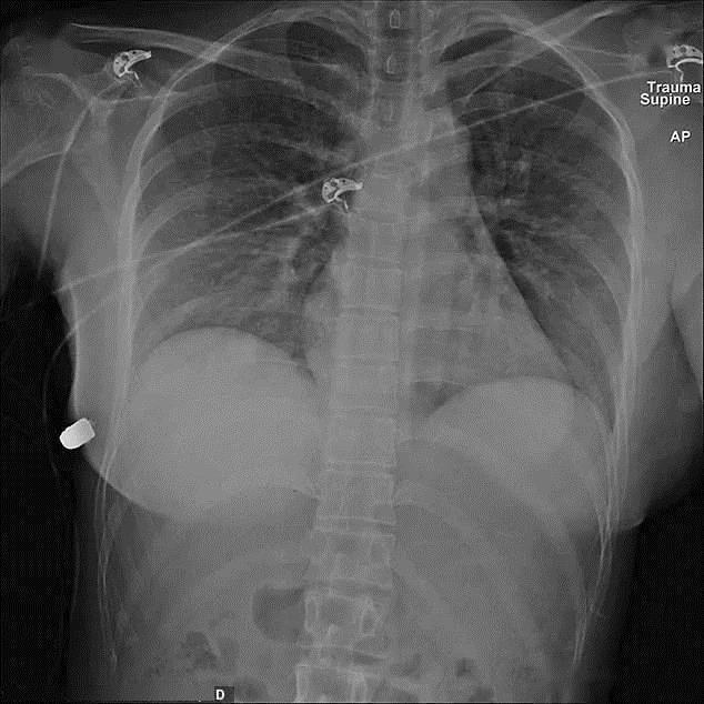 幸存|隆胸硅胶假体还能防弹一女子枪口下幸存,医生看完一脸懵