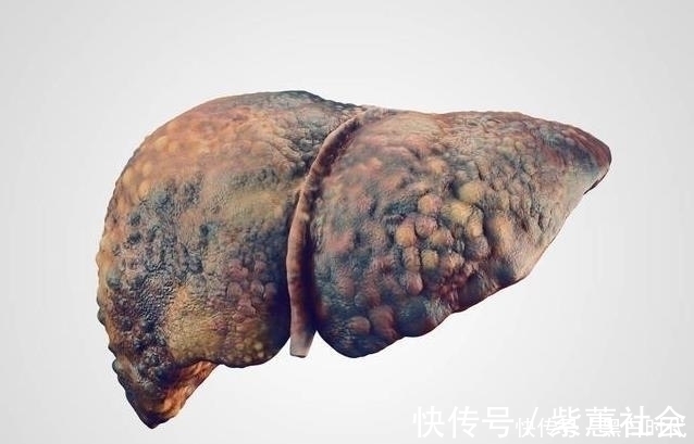 保肝|肝硬化“害怕”3种食物,坚持吃,修复肝细胞,肝越来越好不癌变