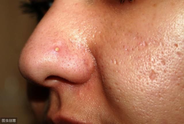 毛孔越来越粗大,这些坏习惯你却一直在做,别再怪护肤没用了!