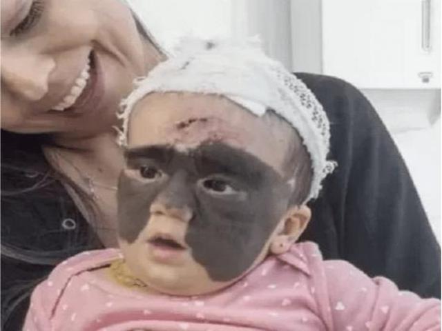 父母|女孩出生就带有“蝙蝠胎记”,做过7次整形手术,现在怎么样了