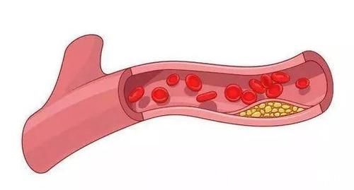 斑块|老年人是不是都会长颈动脉斑块？要紧吗？该咋办？