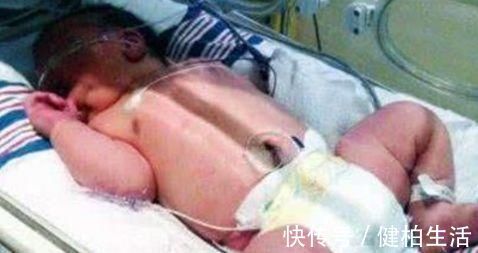 肥胖|产妇孕期胃口惊人致重度肥胖,当胎儿出生那刻,整个医院都乱套了