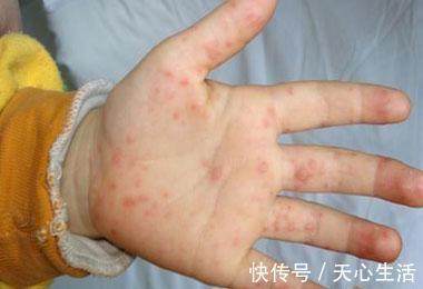 症状|手和脚有3个症状，说明血糖很高了，别忽视，尿毒症会找上你