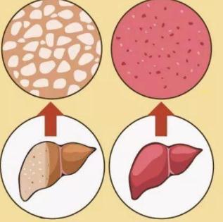 饮食|身体若有脂肪肝,一定会有这些表现,得了脂肪肝如何饮食?