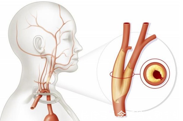 颈动脉狭窄|颈动脉出现硬化斑块,必须吃他汀和阿司匹林?本文辟谣讲出实情