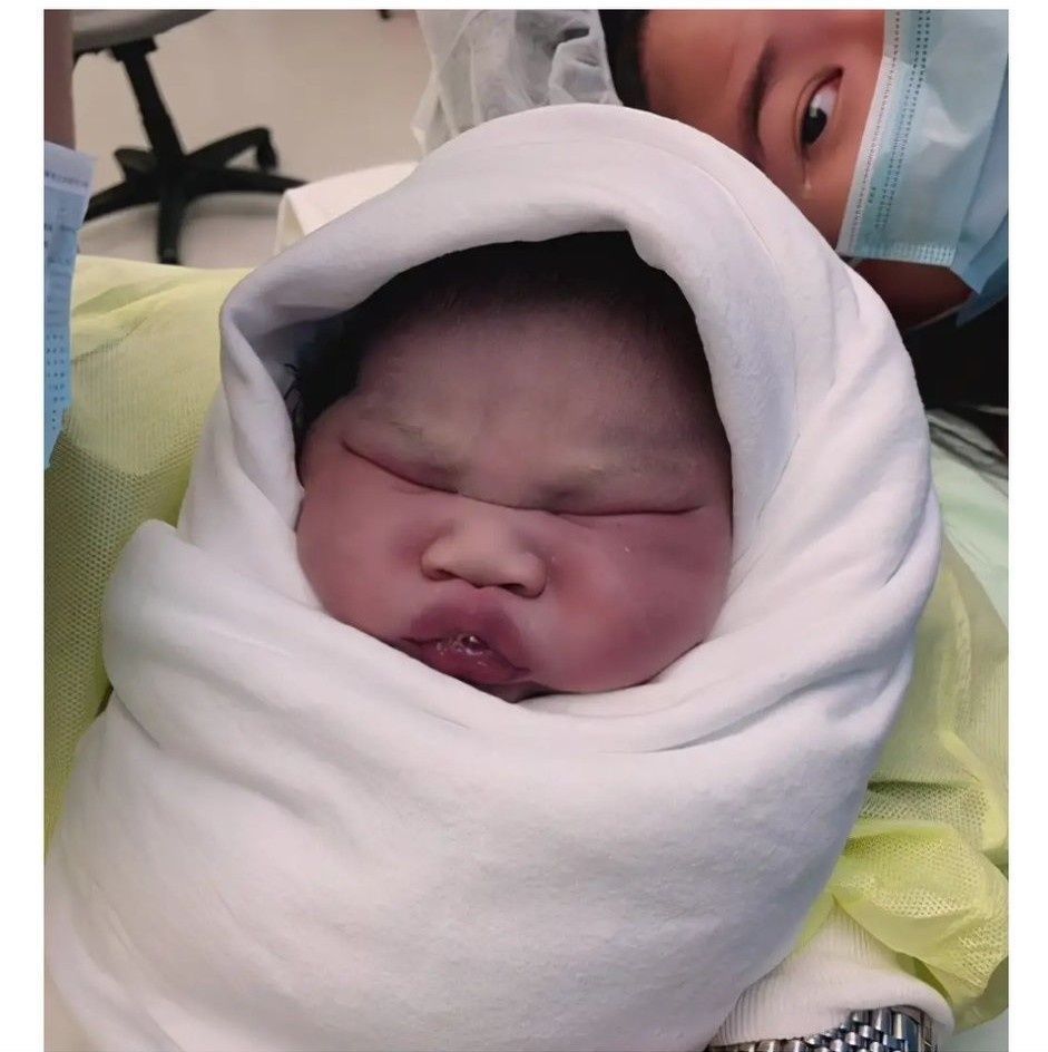 瘀痕|宝宝出生后太丑，妈妈眼角藏泪花抢眼，不用退货等着逆袭吧！