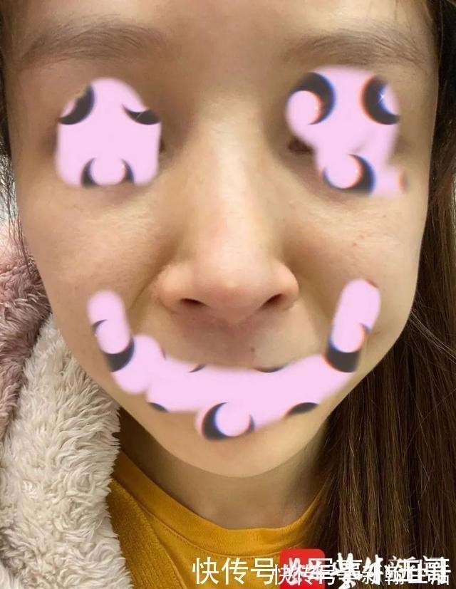 鼻尖 女子整容后山根晃动、鼻尖发白!手术方:很成功,已起诉