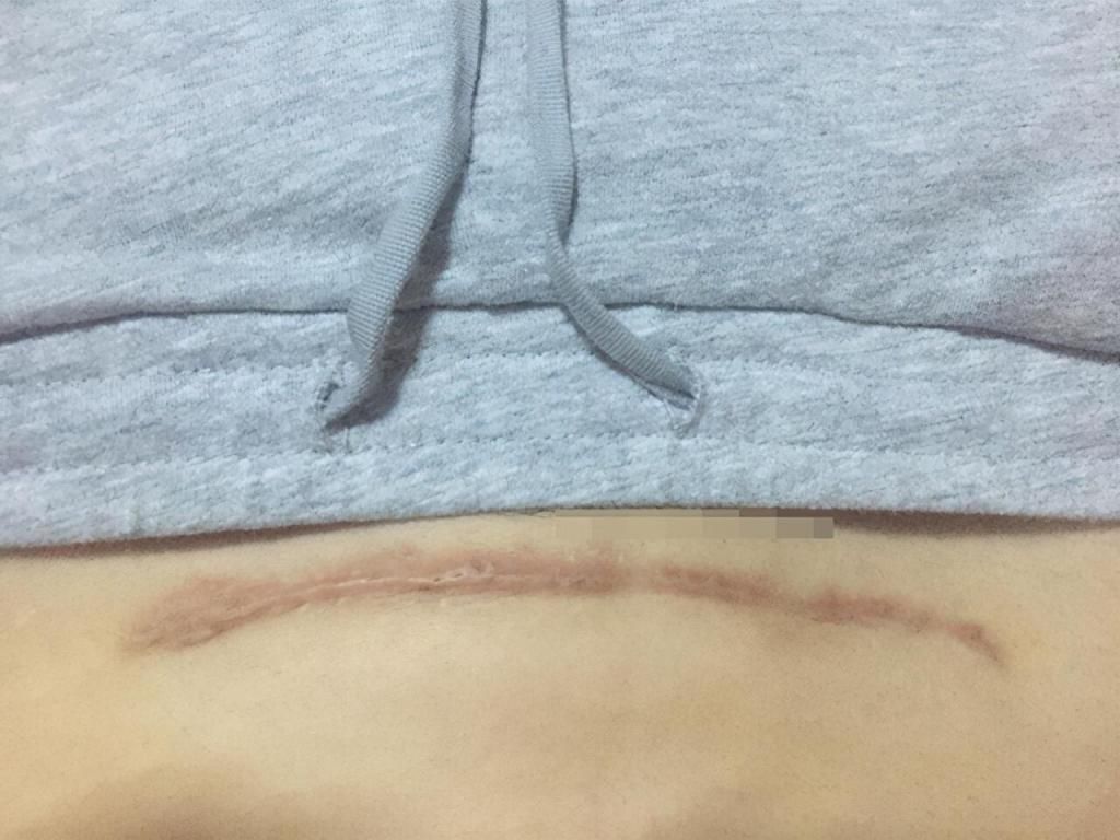 刀口|剖腹产选择“横切”还是“竖切”?别轻视这一刀,两者效果大不同