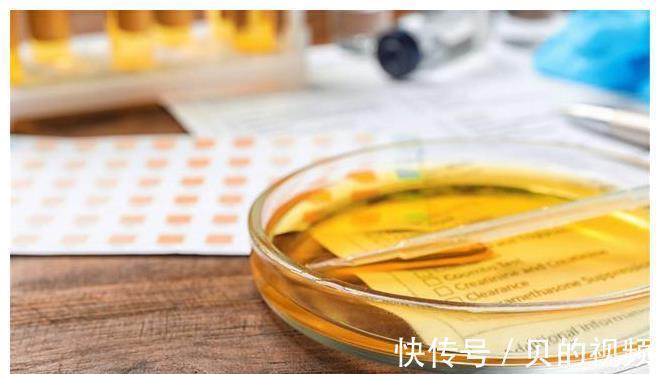 酮症酸中毒|糖尿病上门，看尿液也能略知一二？请看本文分析