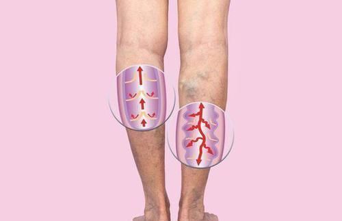 症状|体内有血栓,腿先知!腿部出现这些特征,警惕血管越来越窄