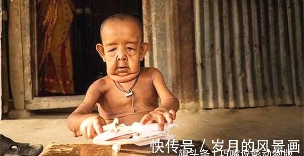 儿童早衰症|印度男童,患怪病,智商超群却长着一副80岁面孔