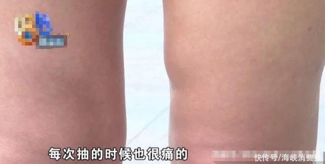 小宋|女子做大腿吸脂手术，术后腿部有积液，跑了40多趟抽积液