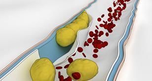 血栓“最怕”这种豆老中医早餐,每天吃一点,降脂溶栓护血管~