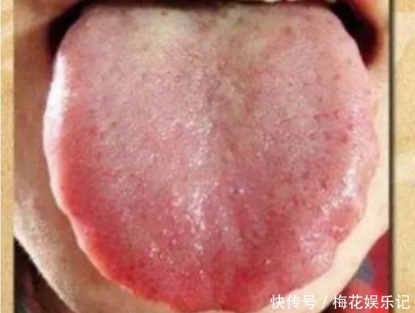 舌头牙印怎么快速消除